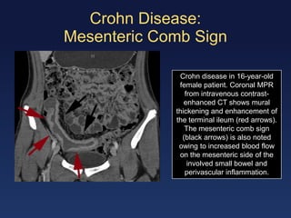 Enteritis and colitis | PDF