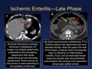 Enteritis Pattern Ct Enteritis and colitis | PDF