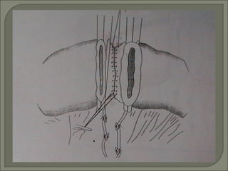  Con el mismo hilo de
sutura (Catgut 000)
se realiza surgete
invaginante y
perforante de
Connel, terminando
en la parte m...