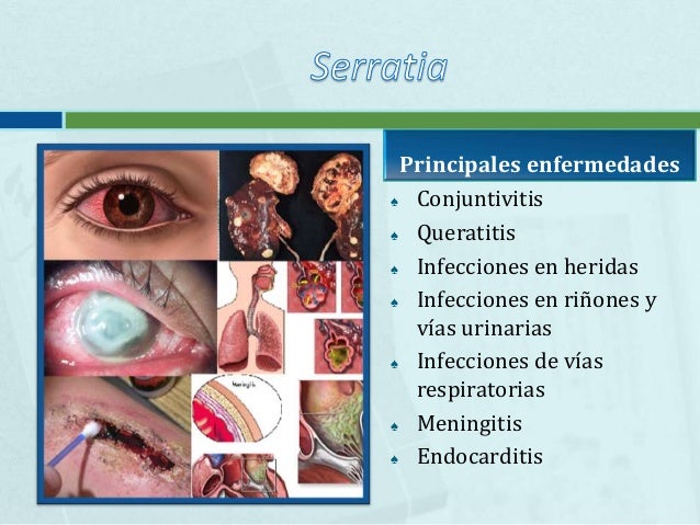 conjuntivitis e infeccion urinaria conjuntivitis e infeccion urinaria