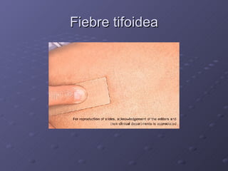 Fiebre tifoidea 