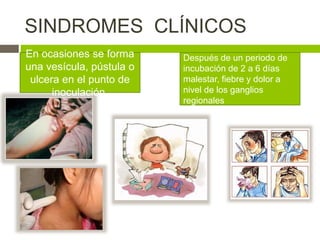 SINDROMES CLÍNICOS
En ocasiones se forma
una vesícula, pústula o
ulcera en el punto de
inoculación.
Después de un periodo de
incubación de 2 a 6 días
malestar, fiebre y dolor a
nivel de los ganglios
regionales
 
