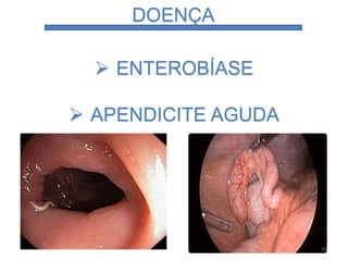 DOENÇA
 ENTEROBÍASE
 APENDICITE AGUDA
10
 