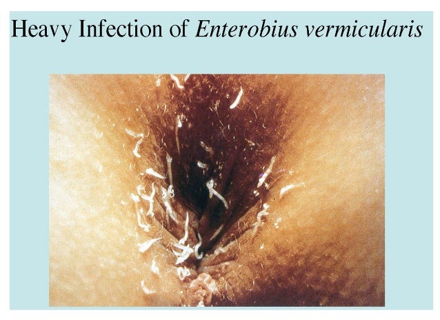 VERMICULARIS ENTEROBIUS EPUB DOWNLOAD VERMICULARIS ENTEROBIUS EPUB DOWNLOAD
