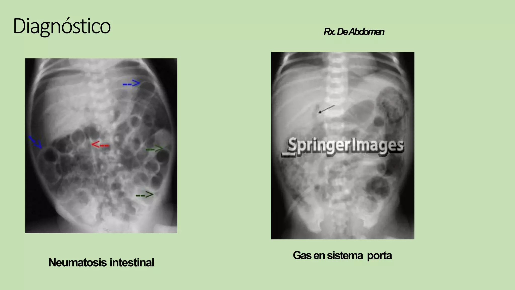 Enterocolitis | PPTX