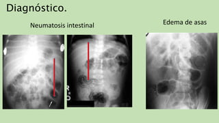 Neumatosis intestinal Edema de asas
Diagnóstico.
 