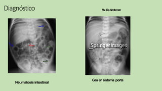 Diagnóstico Rx.DeAbdomen
Gasensistema porta
Neumatosis intestinal
 