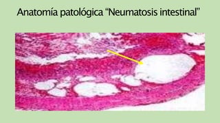 Anatomía patológica “Neumatosisintestinal”
 
