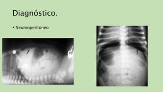 Diagnóstico.
• Neumoperitoneo
 