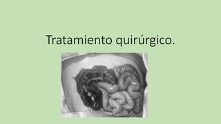 Tratamiento quirúrgico.
 