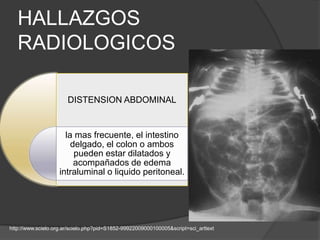 HALLAZGOS
   RADIOLOGICOS

                       DISTENSION ABDOMINAL


                      la mas frecuente, el intestino
                        delgado, el colon o ambos
                         pueden estar dilatados y
                         acompañados de edema
                    intraluminal o liquido peritoneal.




http://www.scielo.org.ar/scielo.php?pid=S1852-99922009000100005&script=sci_arttext
 