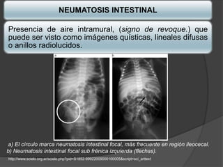 NEUMATOSIS INTESTINAL

Presencia de aire intramural, (signo de revoque.) que
puede ser visto como imágenes quísticas, lineales difusas
o anillos radiolucidos.




a) El círculo marca neumatosis intestinal focal, más frecuente en región ileocecal.
b) Neumatosis intestinal focal sub frénica izquierda (flechas).
http://www.scielo.org.ar/scielo.php?pid=S1852-99922009000100005&script=sci_arttext
 
