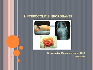 ENTEROCOLITIS NECROSANTE
Universidad Mesoamericana, 2017
Pediatría
 