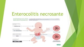 Enterocolitis necrosante
 