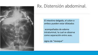 Rx. Distensión abdominal.
El intestino delgado, el colon o
ambos pueden estar dilatados
acompañados de edema
intraluminal, la cual se observa
como separación entre asas.
signo de "revoque"
 