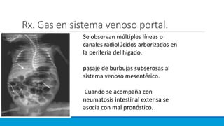 Rx. Gas en sistema venoso portal.
Se observan múltiples líneas o
canales radiolúcidos arborizados en
la periferia del hígado.
pasaje de burbujas subserosas al
sistema venoso mesentérico.
Cuando se acompaña con
neumatosis intestinal extensa se
asocia con mal pronóstico.
 
