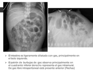 El intestino es ligeramente dilatado con gas, principalmente en
el lado izquierdo.
 El patrón de burbujas de gas observa principalmente en
el cuadrante inferior derecho representa el gas intramural.
De gas libre intraperitoneal está presente anterior (Flechas)
 