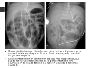  El asas intestinales están dilatadas con gas y han asumido un aspecto
más redondeado y alargado. Parece haber una pequeña cantidad
de gas venoso portal.
 Las asas intestinales han asumido un aspecto más inespecíficos, que
puede reflejar un engrosamiento de la pared intestinal o una
acumulación de líquido dentro de la luz o en la cavidad peritoneal
cavidad.
 