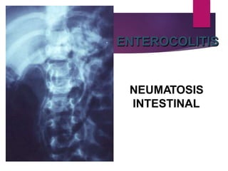 ENTEROCOLITIS
NEUMATOSIS
INTESTINAL
 