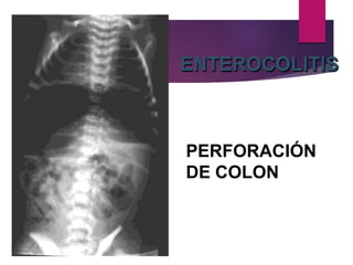 ENTEROCOLITIS
PERFORACIÓN
DE COLON
 