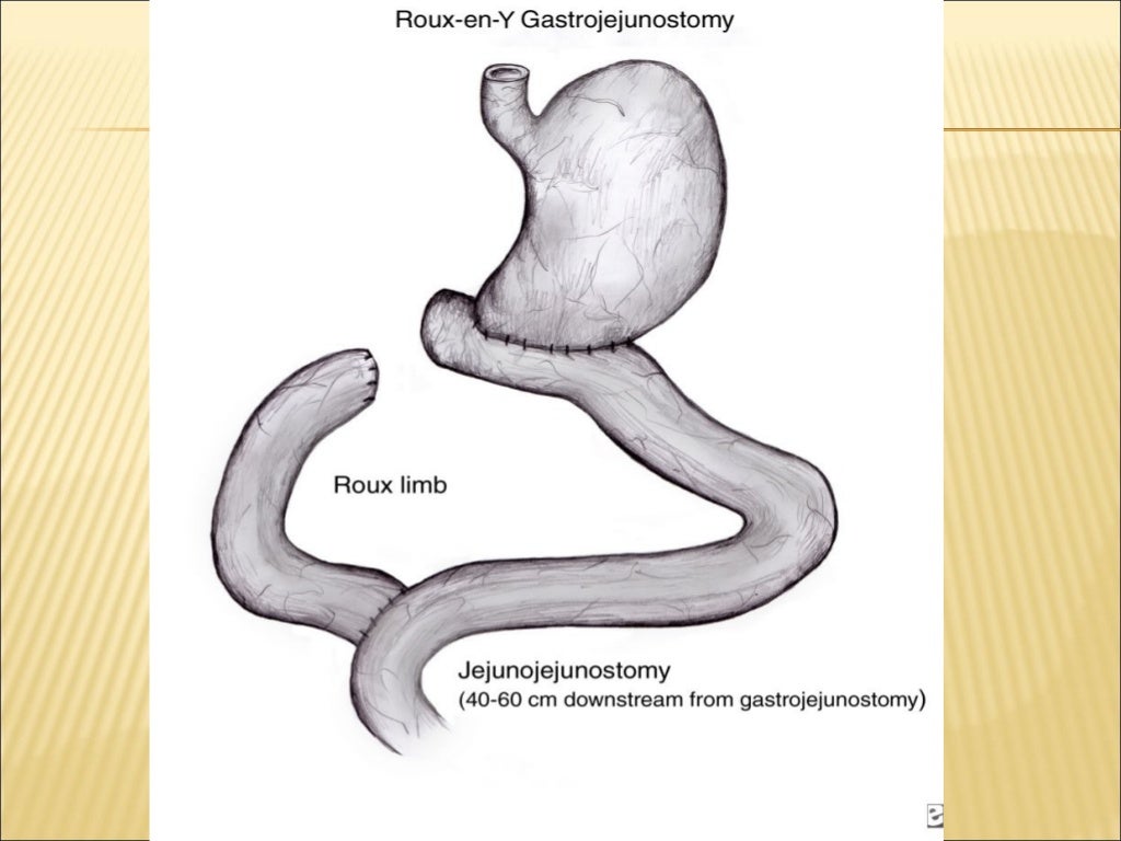 Enterocutaneous fistulas ppt