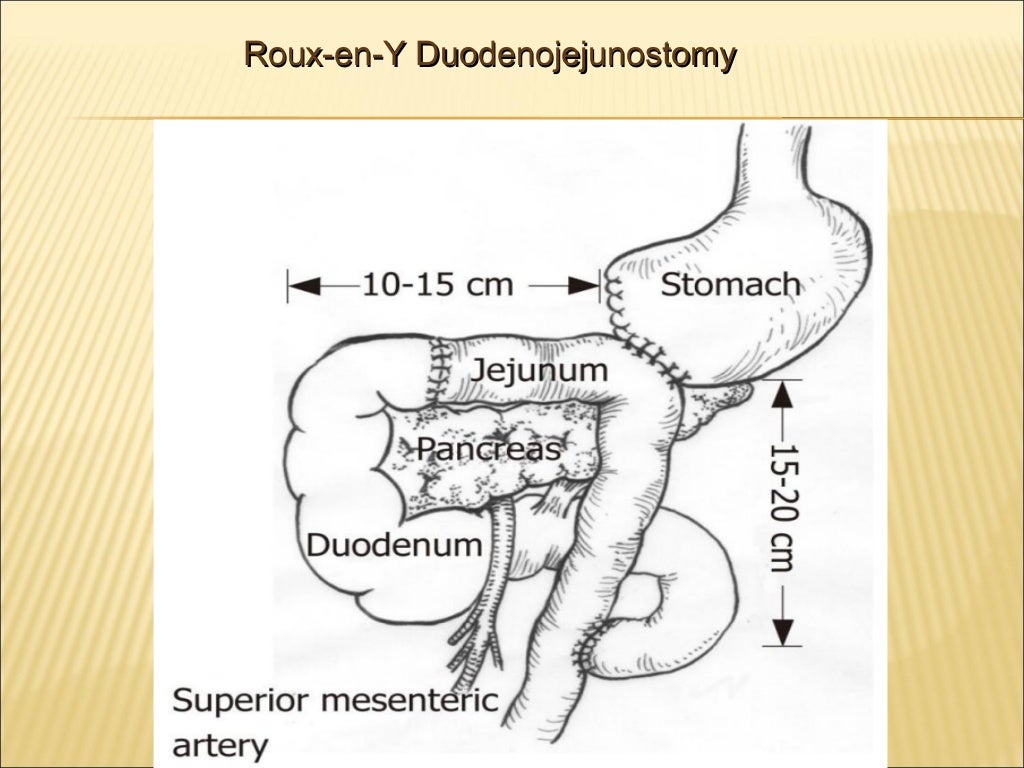Enterocutaneous fistulas ppt