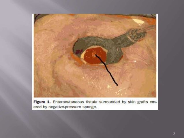 Enterocutaneous fistula