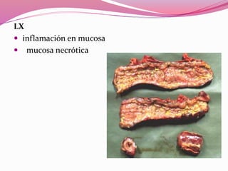 LX
 inflamación en mucosa
 mucosa necrótica
 