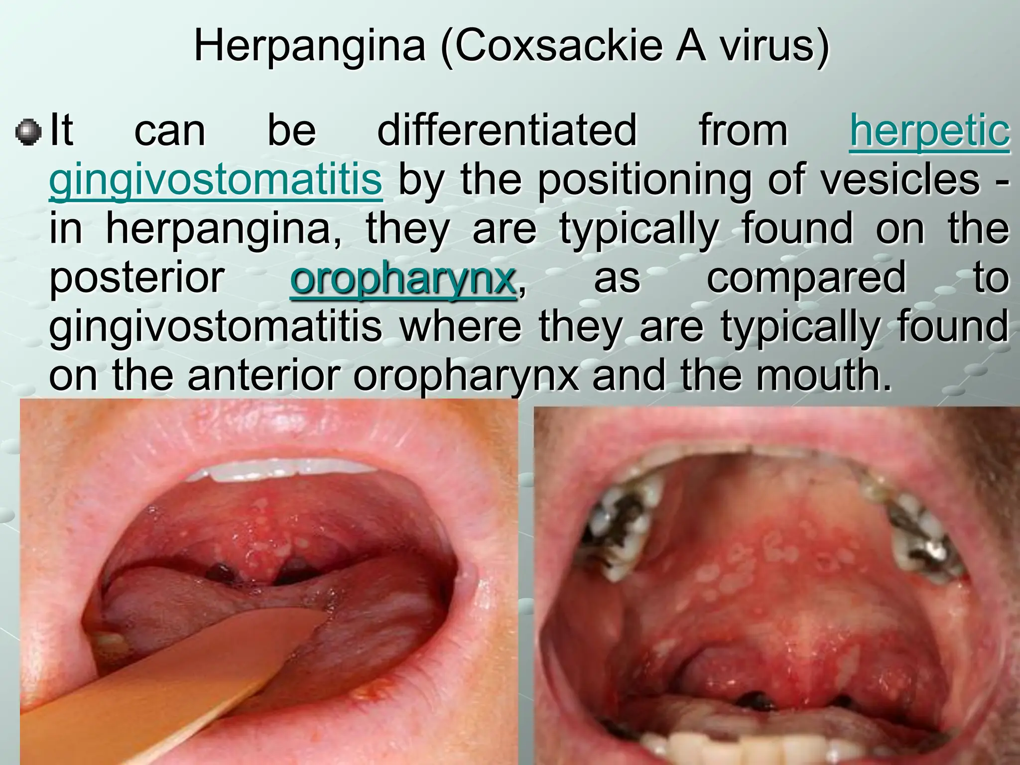 Enteroviral_infection Department of Children Infection Diseases.pdf