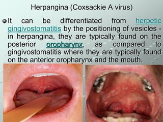Enteroviral infection Department Of Children Infection Diseases pdf Enteroviral infection Department Of Children Infection Diseases pdf
