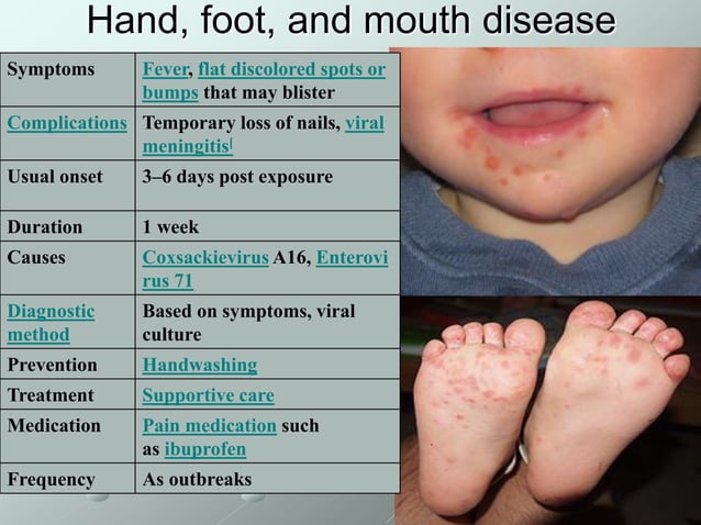 Enteroviral_infection Department of Children Infection Diseases.pdf