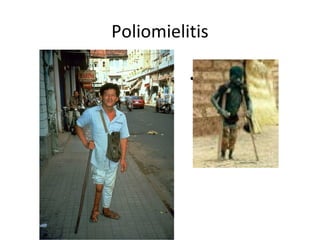 Poliomielitis
• ..
 