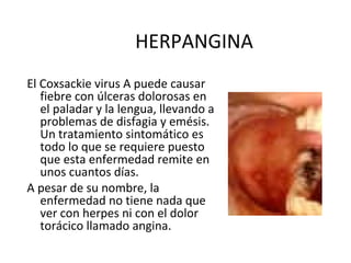 HERPANGINA
El Coxsackie virus A puede causar
fiebre con úlceras dolorosas en
el paladar y la lengua, llevando a
problemas de disfagia y emésis.
Un tratamiento sintomático es
todo lo que se requiere puesto
que esta enfermedad remite en
unos cuantos días.
A pesar de su nombre, la
enfermedad no tiene nada que
ver con herpes ni con el dolor
torácico llamado angina.
 