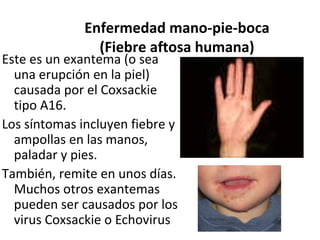 Enfermedad mano-pie-boca
(Fiebre aftosa humana)
Este es un exantema (o sea
una erupción en la piel)
causada por el Coxsackie
tipo A16.
Los síntomas incluyen fiebre y
ampollas en las manos,
paladar y pies.
También, remite en unos días.
Muchos otros exantemas
pueden ser causados por los
virus Coxsackie o Echovirus
 