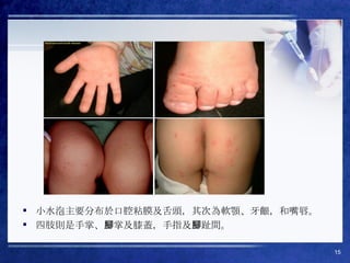 小水泡主要分布於口腔粘膜及舌頭，其次為軟顎、牙齦，和嘴唇。 四肢則是手掌、腳掌及膝蓋，手指及腳趾間。 