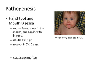 Pathogenesis
• Hand Foot and
  Mouth Disease
  – causes fever, sores in the
    mouth, and a rash with
    blisters.
                                 When pretty baby gets HFMD
  – children <10 yr.
  – recover in 7–10 days.



  – Coxsackievirus A16
 