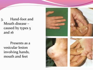 3. Hand-foot and
Mouth disease –
caused by types 5
and 16
Presents as a
vesicular lesion
involving hands,
mouth and feet
 