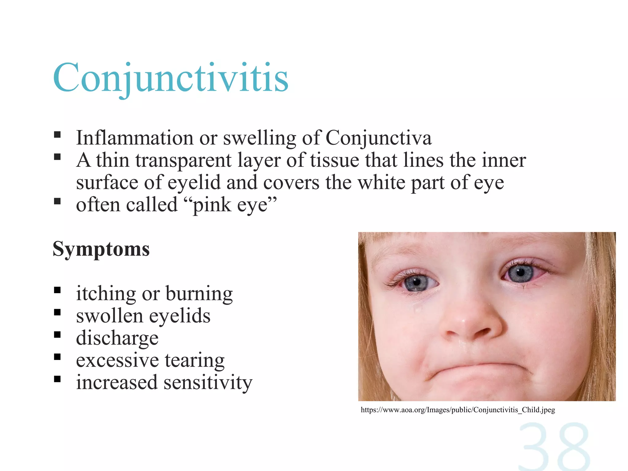 Conjunctivitis
 Inflammation or swelling of Conjunctiva
 A thin transparent layer of tissue that lines the inner
surface of eyelid and covers the white part of eye
 often called “pink eye”
Symptoms
 itching or burning
 swollen eyelids
 discharge
 excessive tearing
 increased sensitivity
https://www.aoa.org/Images/public/Conjunctivitis_Child.jpeg
 
