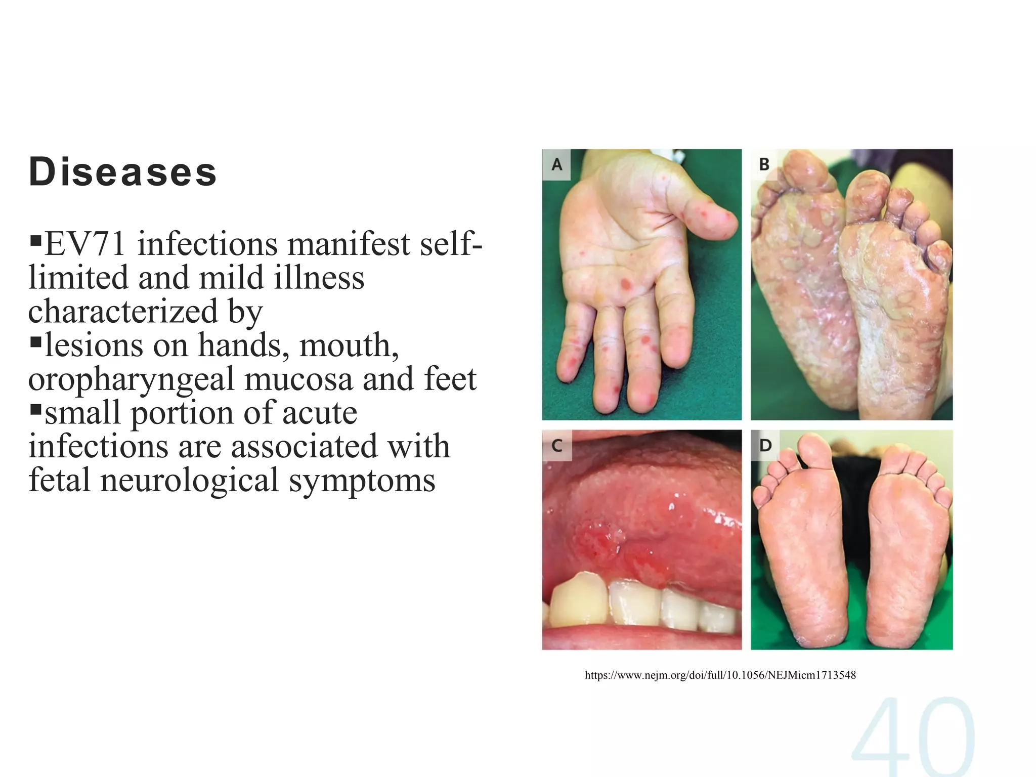 Diseases
EV71 infections manifest self-
limited and mild illness
characterized by
lesions on hands, mouth,
oropharyngeal mucosa and feet
small portion of acute
infections are associated with
fetal neurological symptoms
https://www.nejm.org/doi/full/10.1056/NEJMicm1713548
 