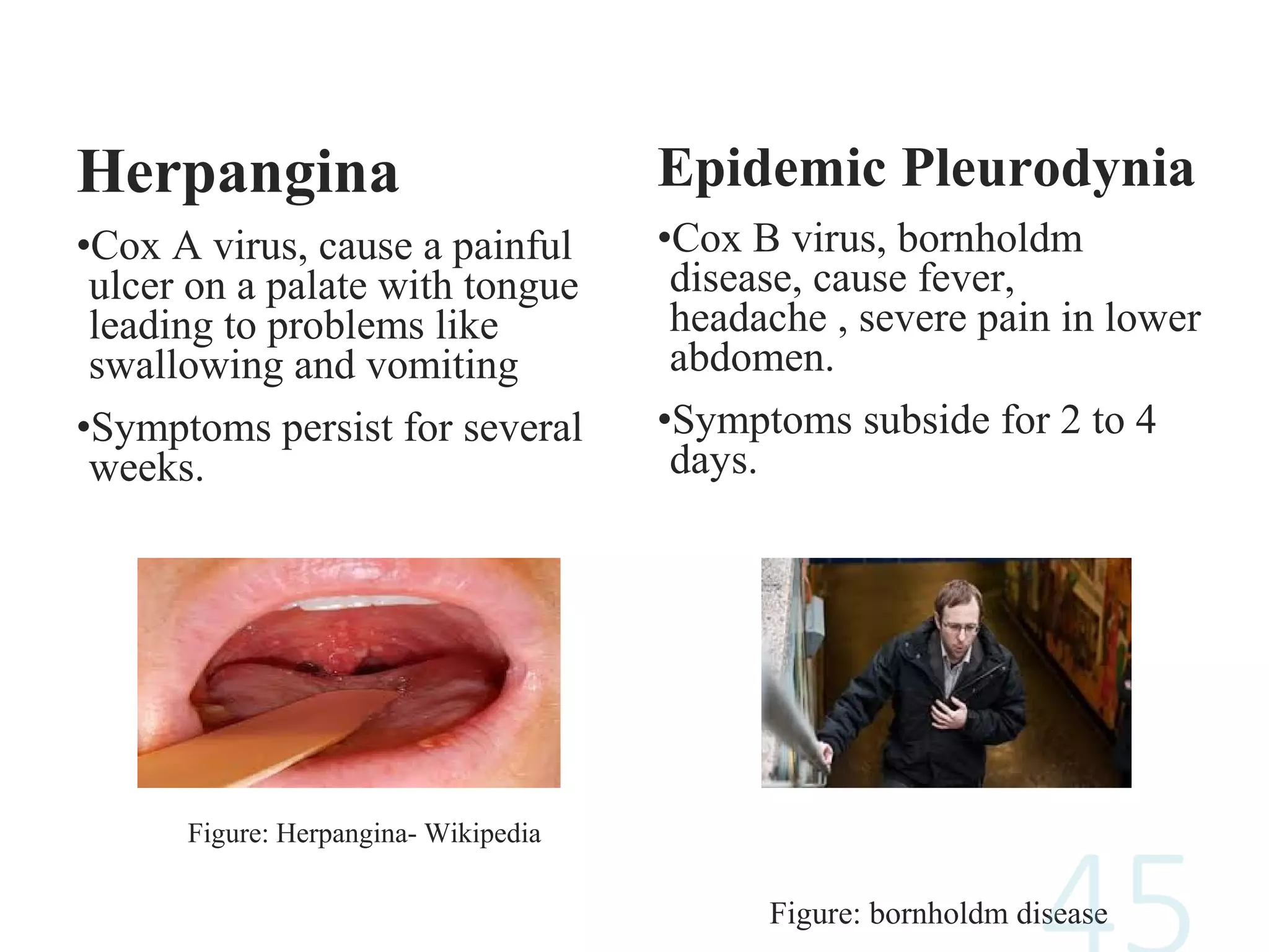 Herpangina
•Cox A virus, cause a painful
ulcer on a palate with tongue
leading to problems like
swallowing and vomiting
•Symptoms persist for several
weeks.
Figure: Herpangina- Wikipedia
Epidemic Pleurodynia
•Cox B virus, bornholdm
disease, cause fever,
headache , severe pain in lower
abdomen.
•Symptoms subside for 2 to 4
days.
Figure: bornholdm disease
 