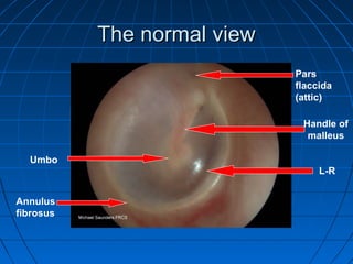 TThhee nnoorrmmaall vviieeww 
Umbo 
Annulus 
fibrosus 
Pars 
flaccida 
(attic) 
Handle of 
malleus 
L-R 
 