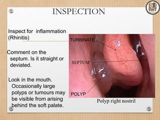 INSPECTION
Inspect for inflammation
(Rhinitis)
Comment on the
septum. Is it straight or
deviated.
Look in the mouth.
Occasionally large
polyps or tumours may
be visible from arising
behind the soft palate.
Polyp right nostril
TURBINATE
SEPTUM
 