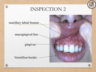 Vermillion border
maxillary labial frenum
mucogingival line
gingivae
INSPECTION 2
 