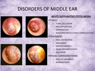 DISORDERS OF MIDDLE EAR ACUTE SUPPURATIVE OTITIS MEDIA STAGES TUBAL OCCLUSION PRESUPPURATION SUPPURATION DISCHARGE/RESOLUTION/ COMPLICATIONS TREATMENT ORAL ANTIBIOTICS ANALGESICS ANTIHISTAMINICS NASAL DECONGESTANTS FOLLOWUP SPECIAL CONSIDERATIONS ROLE OF EAR DROPS MYRINGOTOMY 