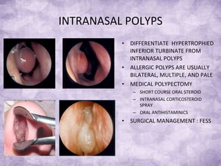 INTRANASAL POLYPS DIFFERENTIATE  HYPERTROPHIED INFERIOR TURBINATE FROM INTRANASAL POLYPS ALLERGIC POLYPS ARE USUALLY BILATERAL, MULTIPLE, AND PALE MEDICAL POLYPECTOMY SHORT COURSE ORAL STEROID INTRANASAL CORTICOSTEROID SPRAY ORAL ANTIHISTAMINICS SURGICAL MANAGEMENT : FESS 