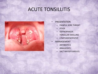 ACUTE TONSILLITIS PRESENTATION PAINFUL SORE THROAT FEVER ODYNOPHAGIA TONSILLAR SWELLING LYMPHADENOPATHY MANAGEMENT ANTIBIOTICS ANALGESICS SALT WATER GARGLES 