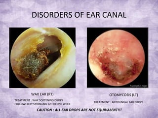 DISORDERS OF EAR CANAL WAX EAR (RT) OTOMYCOSIS (LT) TREATMENT : WAX SOFTENING DROPS FOLLOWED BY SYRINGING AFTER ONE WEEK TREATMENT : ANTIFUNGAL EAR DROPS CAUTION : ALL EAR DROPS ARE NOT EQUIVALENT!!! 