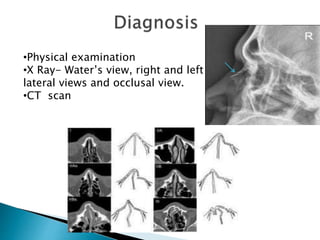 •Physical examination
•X Ray- Water’s view, right and left
lateral views and occlusal view.
•CT scan
 