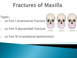 Types-
1. Le Fort I (transverse) fracture
2. Le Fort II (pyramidal) fracture
3. Le Fort III (craniofacial dysfunction)
 