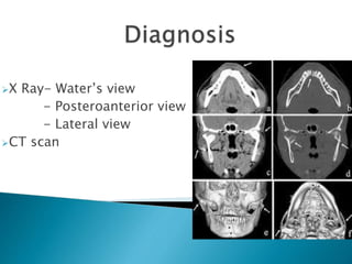 X Ray- Water’s view
- Posteroanterior view
- Lateral view
CT scan
 